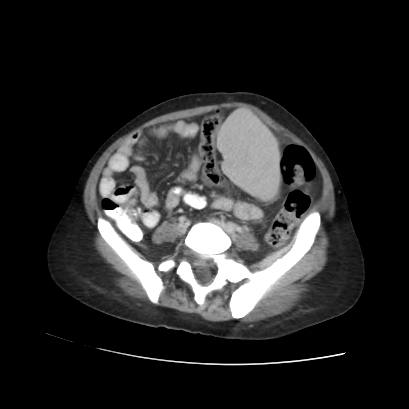 File:Acute calculous cholecystitis in patient with osteopetrosis (Radiopaedia 77871-90159 Axial C+ portal venous phase 57).jpg