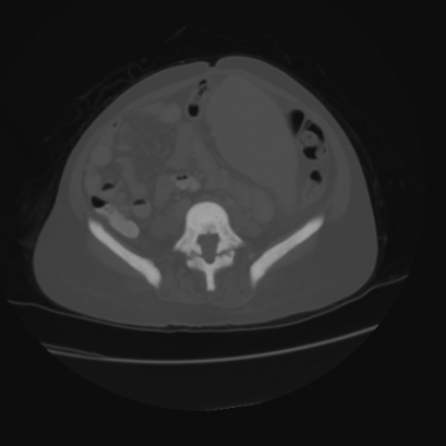 File:Acute calculous cholecystitis in patient with osteopetrosis (Radiopaedia 77871-90159 Axial bone window 33).jpg