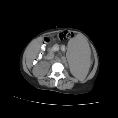 File:Acute calculous cholecystitis in patient with osteopetrosis (Radiopaedia 77871-90159 Axial non-contrast 46).jpg
