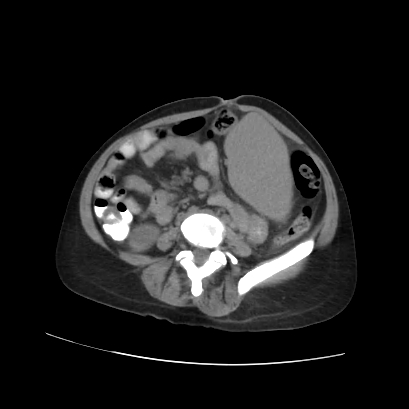 File:Acute calculous cholecystitis in patient with osteopetrosis (Radiopaedia 77871-90159 Axial non-contrast 53).jpg