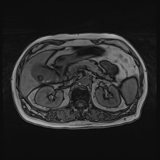 Acute cholecystitis (Radiopaedia 72392-82923 Axial T1 out-of-phase 54).jpg