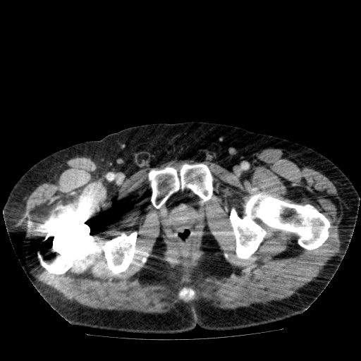 File:Acute cholecystitis and incidental left sided IVC (Radiopaedia 49352-54459 Axial C+ portal venous phase 156).jpg