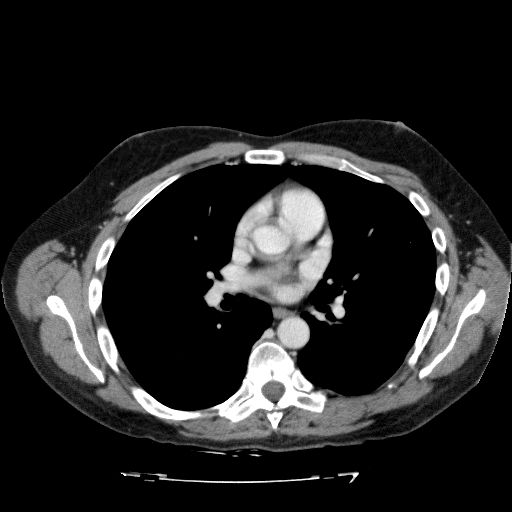 File:Acute cholecystitis and incidental left sided IVC (Radiopaedia 49352-54459 Axial C+ portal venous phase 3).jpg