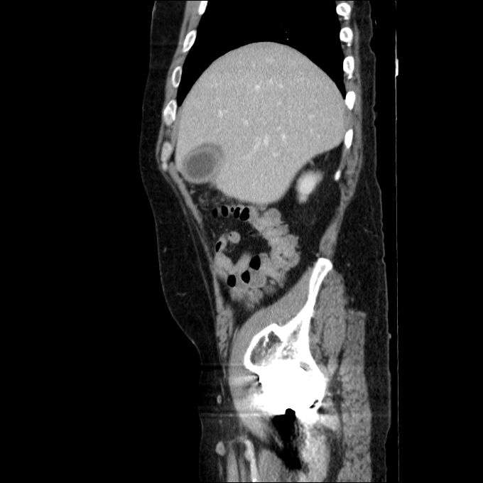 Acute cholecystitis and incidental left sided IVC (Radiopaedia 49352-54459 Sagittal C+ portal venous phase 71).jpg
