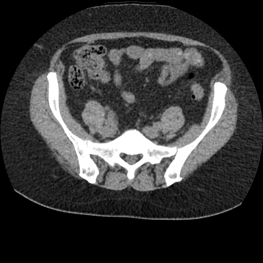 File:Acute cholecystitis and ureteric colic (Radiopaedia 42330-45444 Axial prone 77).jpg