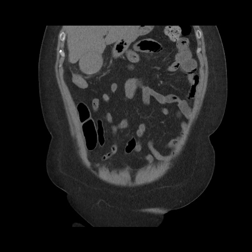 Acute cholecystitis with tensile fundus sign (Radiopaedia 71394-81723 Coronal non-contrast 43).jpg