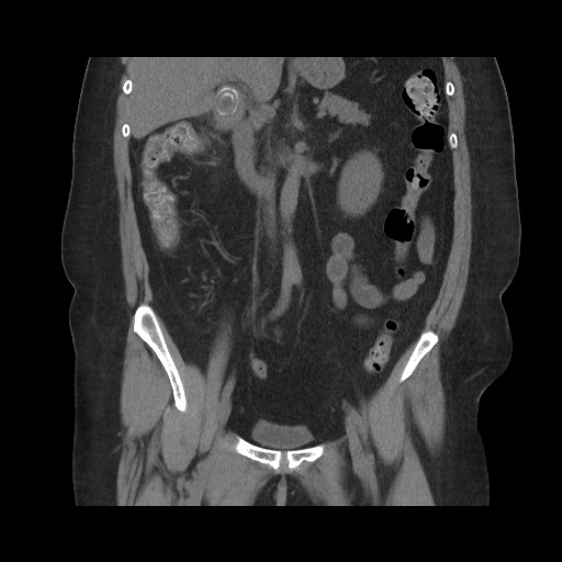 Acute cholecystitis with tensile fundus sign (Radiopaedia 71394-81723 Coronal non-contrast 66).jpg