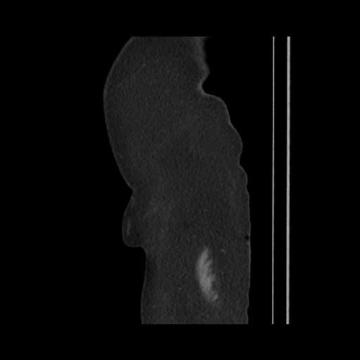 Acute cholecystitis with tensile fundus sign (Radiopaedia 71394-81723 Sagittal non-contrast 23).jpg