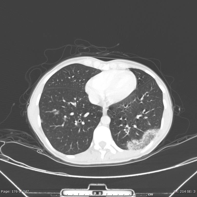 Acute eosinophilic pneumonia (Radiopaedia 48211-53073 Axial lung window 63).jpg