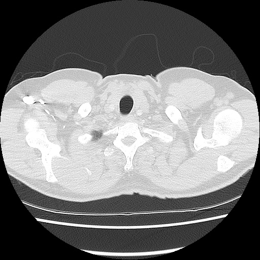 Acute epicardial fat necrosis (Radiopaedia 42327-45440 Axial lung window 7).jpg