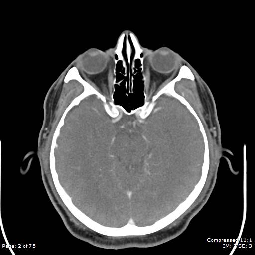Acute epiglottitis (Radiopaedia 54375-60590 Axial C+ arterial phase 2).jpg