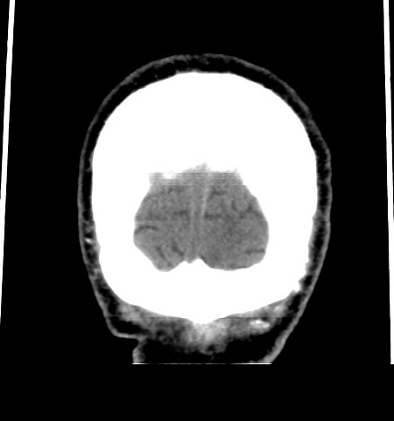 Acute left anterior cerebral artery territory infarction (Radiopaedia 51785-57578 Coronal non-contrast 56).jpg