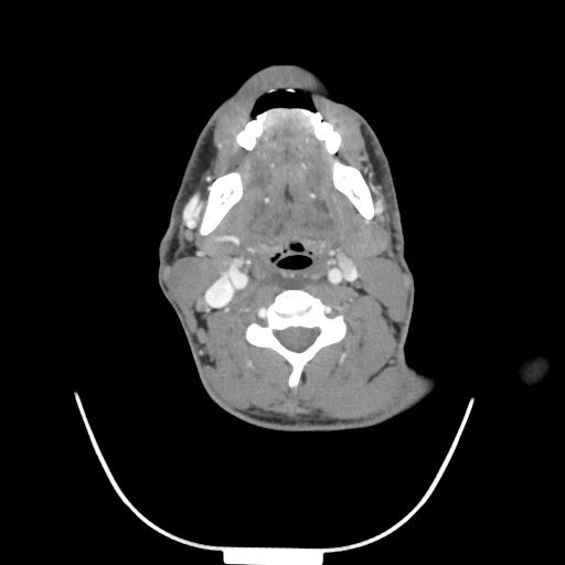 Acute longus colli calcific tendinitis (Radiopaedia 72495-83036 Axial C+ arterial phase 43).jpg