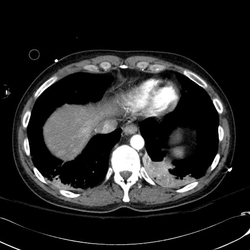 Acute myocardial infarction in CT (Radiopaedia 39947-42415 Axial C+ arterial phase 113).jpg