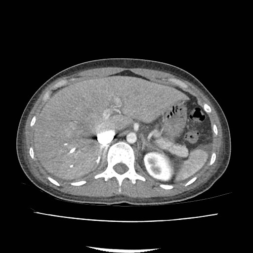 Acute myocarditis (Radiopaedia 55988-62613 Axial C+ portal venous phase 20).jpg