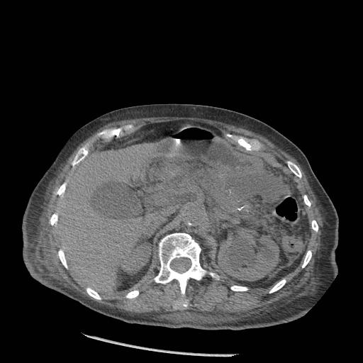 Acute on chronic pancreatitis (Radiopaedia 13233-13244 Axial non-contrast 27).jpg