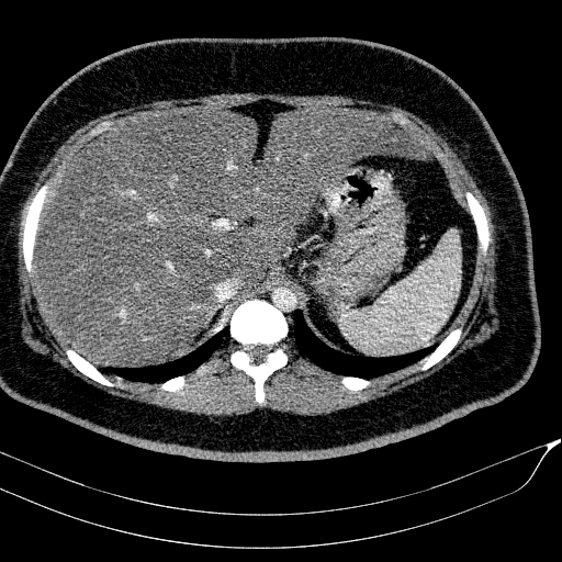 Acute on chronic pancreatitis (Radiopaedia 80902-94423 Axial C+ portal venous phase 37).jpg