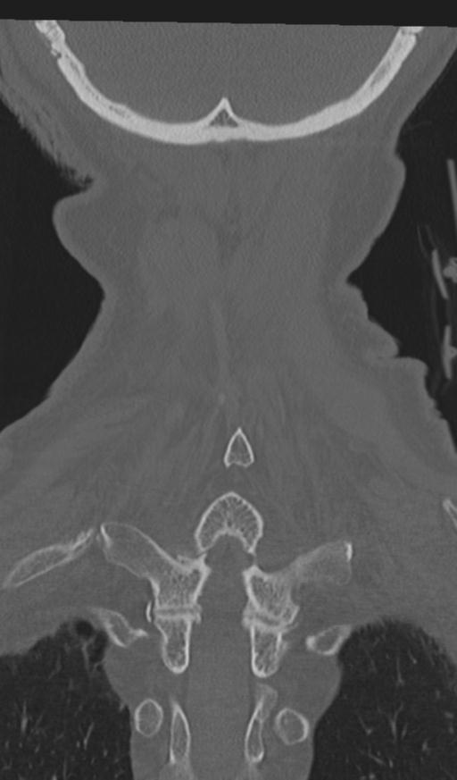 Acute on chronic subdural hematoma and thoracic vertebral injury in a multitrauma patient (Radiopaedia 31698-32619 Coronal bone window 58).jpg