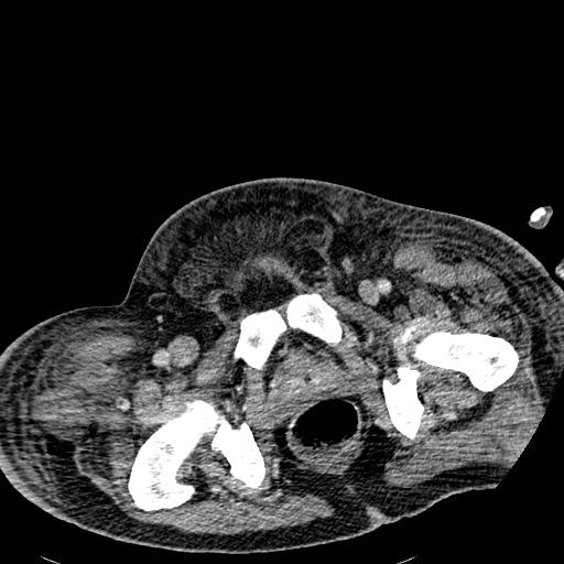 Acute pancreatic necrosis (Radiopaedia 13560-18501 Axial C+ portal venous phase 148).jpg