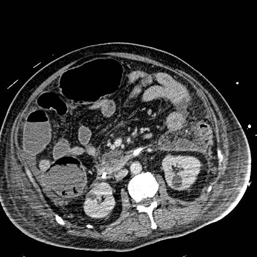 Acute pancreatic necrosis (Radiopaedia 13560-18501 Axial C+ portal venous phase 68).jpg