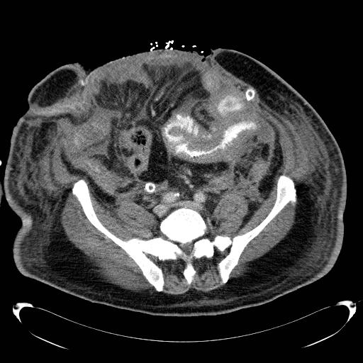 Acute pancreatic necrosis (Radiopaedia 13560-18503 Axial C+ portal venous phase 57).jpg