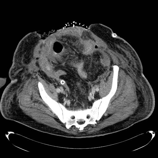 Acute pancreatic necrosis (Radiopaedia 13560-18503 Axial C+ portal venous phase 66).jpg