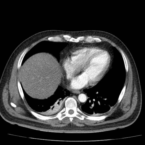 Acute pancreatitis (Radiopaedia 26663-26813 Axial C+ arterial phase 11).jpg