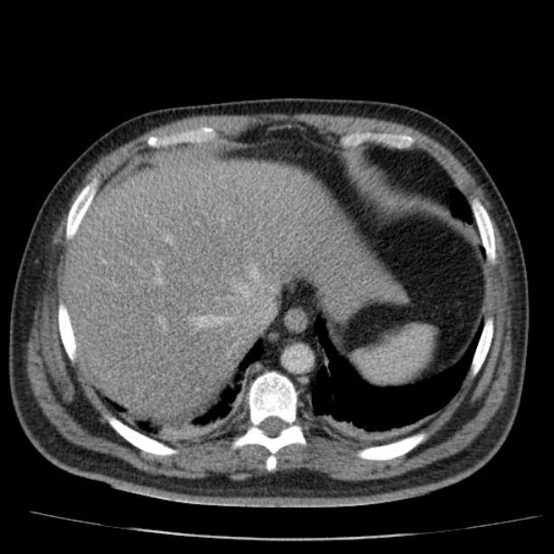 Acute pancreatitis (Radiopaedia 26663-26813 Axial C+ portal venous phase 13).jpg