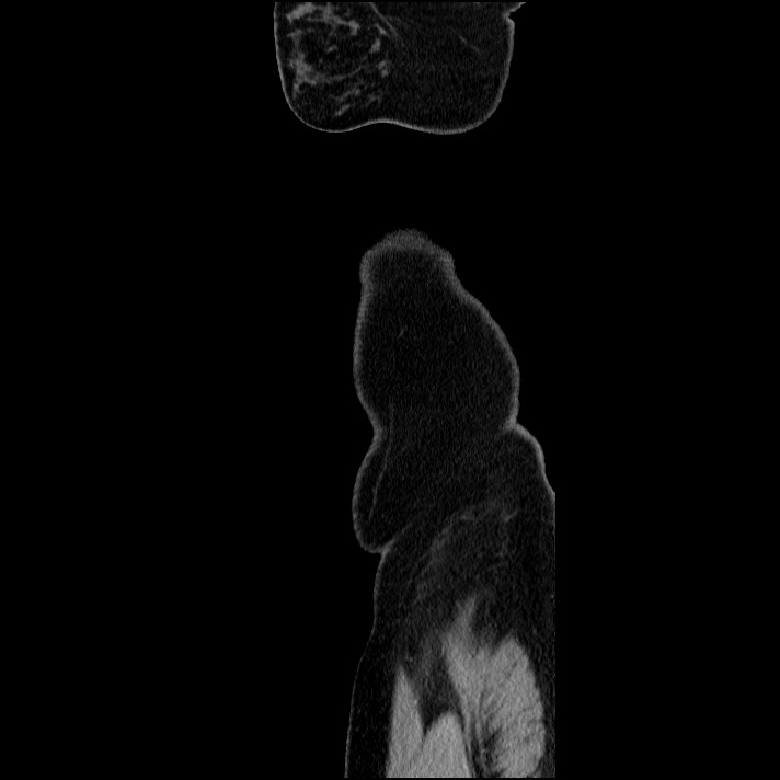 Acute pancreatitis (Radiopaedia 69236-79012 Sagittal C+ portal venous phase 9).jpg