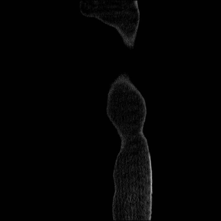 Acute pancreatitis (Radiopaedia 69236-79012 Sagittal C+ portal venous phase 97).jpg