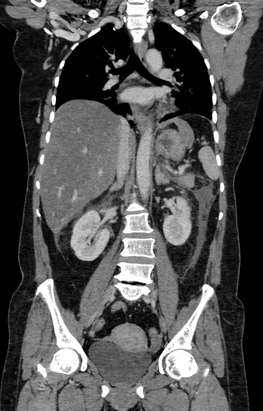 Acute pancreatitis (Radiopaedia 80007-93285 Coronal C+ portal venous phase 78).jpg