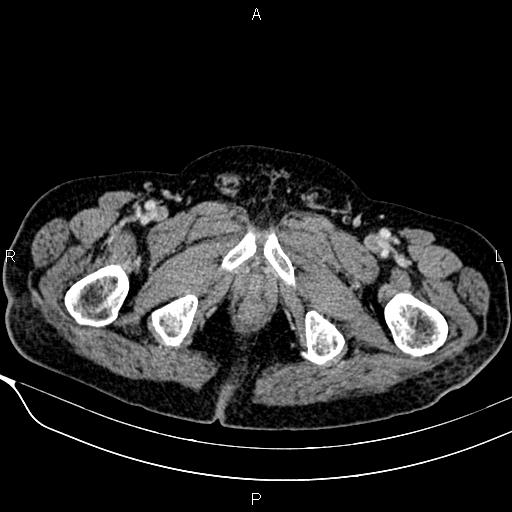 Acute pancreatitis (Radiopaedia 85146-100701 Axial C+ portal venous phase 66).jpg