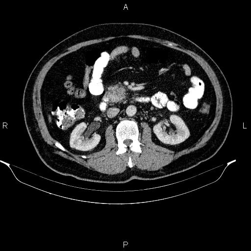 File:Acute pancreatitis (Radiopaedia 85390-101010 Axial C+ portal venous phase 47).jpg