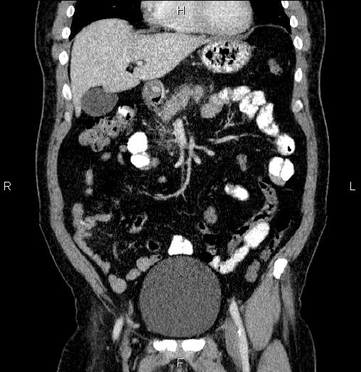Acute pancreatitis (Radiopaedia 85390-101010 Coronal C+ portal venous phase 22).jpg