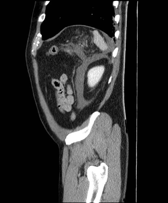 Acute pancreatitis - Balthazar E (Radiopaedia 23080-23110 Sagittal C+ portal venous phase 86).jpg