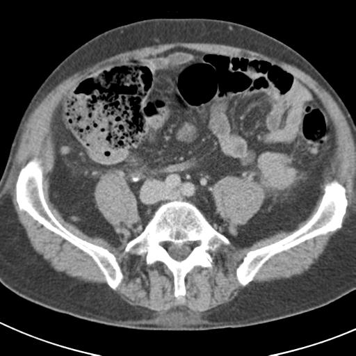 Acute pancreatitis and walled-off necrosis (Radiopaedia 29888-30403 Axial C+ delayed 57).jpg