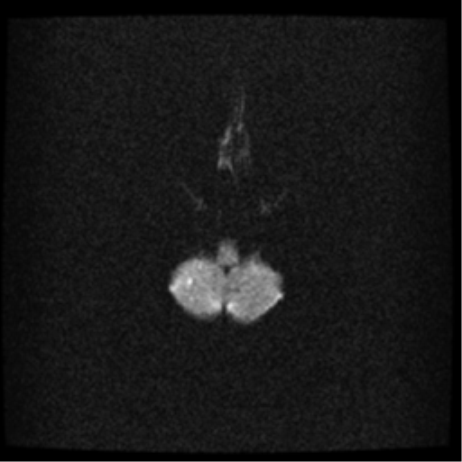 File:Acute pontine infarct from vertebral artery dissection (Radiopaedia 34111-35370 Axial DWI 4).png
