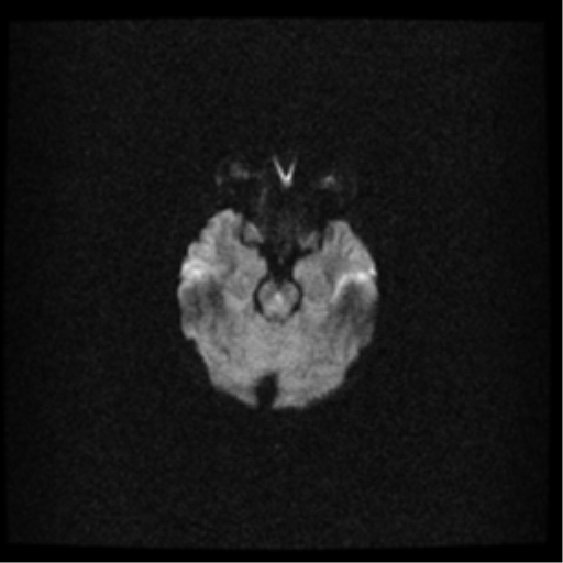 File:Acute pontine infarct from vertebral artery dissection (Radiopaedia 34111-35370 Axial DWI 8).png