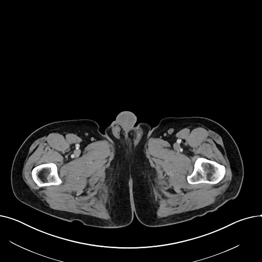 Acute renal infarction (Radiopaedia 59375-66736 Axial C+ portal venous phase 139).jpg