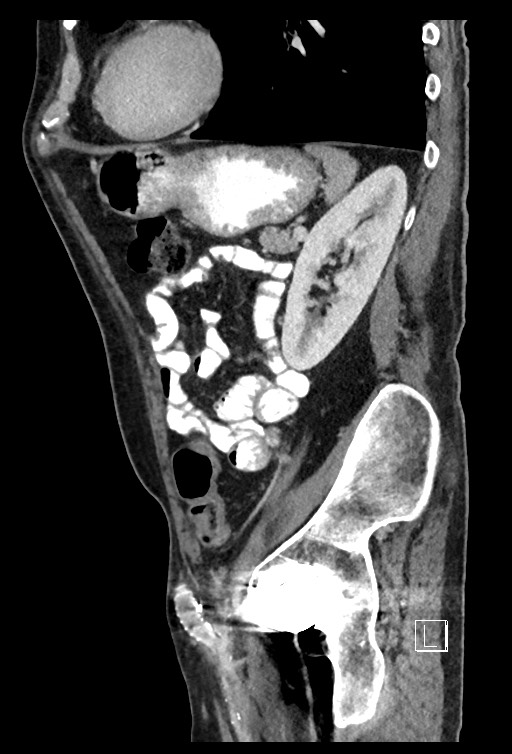 Acute renal infarction - rim capsular enhancement (Radiopaedia 59833-67270 Sagittal C+ portal venous phase 29).jpg