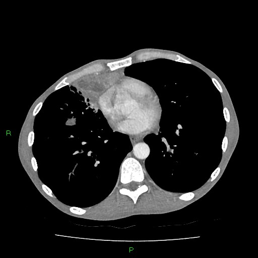 File:Acute right lung abscess (Radiopaedia 34806-36258 Axial C+ arterial phase 119).jpg