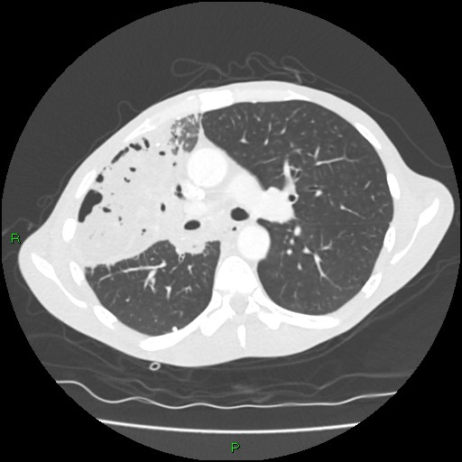 Acute right lung abscess (Radiopaedia 34806-36258 Axial lung window 78).jpg