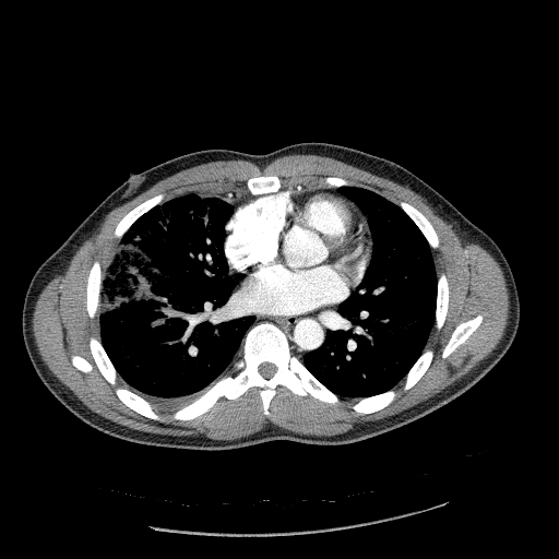 Acute segmental pulmonary emboli and pulmonary infarction (Radiopaedia 62264-70444 Axial C+ CTPA 67).jpg