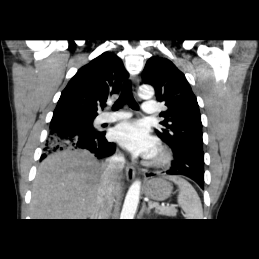 Acute segmental pulmonary emboli and pulmonary infarction (Radiopaedia 62264-70444 Coronal C+ CTPA 29).jpg