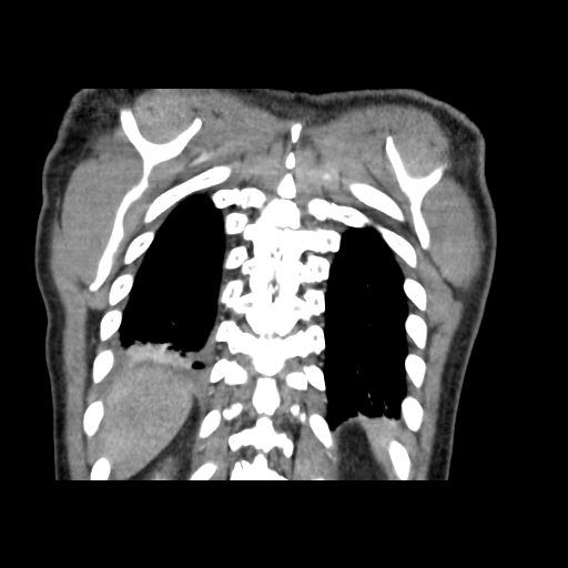 Acute segmental pulmonary emboli and pulmonary infarction (Radiopaedia 62264-70444 Coronal C+ CTPA 50).jpg