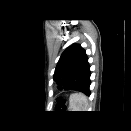 File:Acute segmental pulmonary emboli and pulmonary infarction (Radiopaedia 62264-70444 Sagittal C+ CTPA 56).jpg