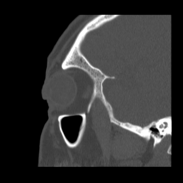 Acute sinusitis (Radiopaedia 23161-23215 Sagittal bone window 52).jpg