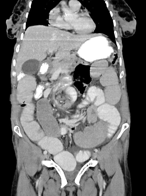Acute small bowel (ileal) volvulus (Radiopaedia 71740-82139 Coronal C+ portal venous phase 45).jpg