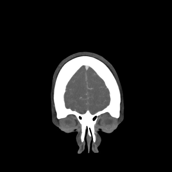 Acute subarachnoid hemorrhage and accessory anterior cerebral artery (Radiopaedia 69231-79009 Coronal C+ arterial phase 11).jpg