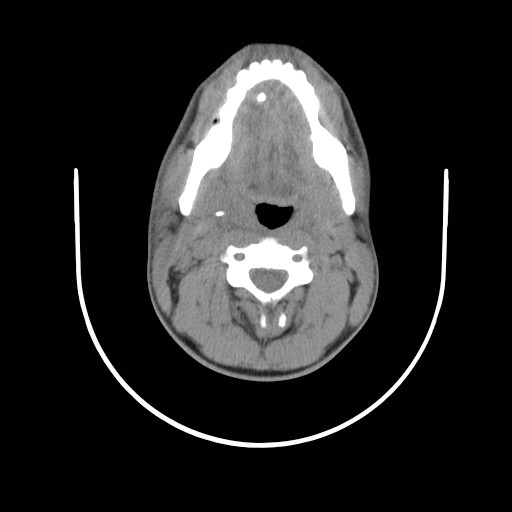 File:Acute submandibular sialadenitis secondary to ductal stone (Radiopaedia 27999-28267 Axial non-contrast 10).jpg